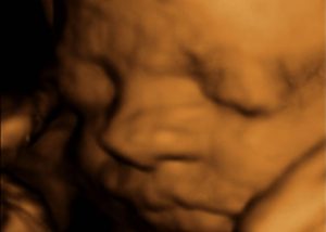 Ultraschallbild Babykopf